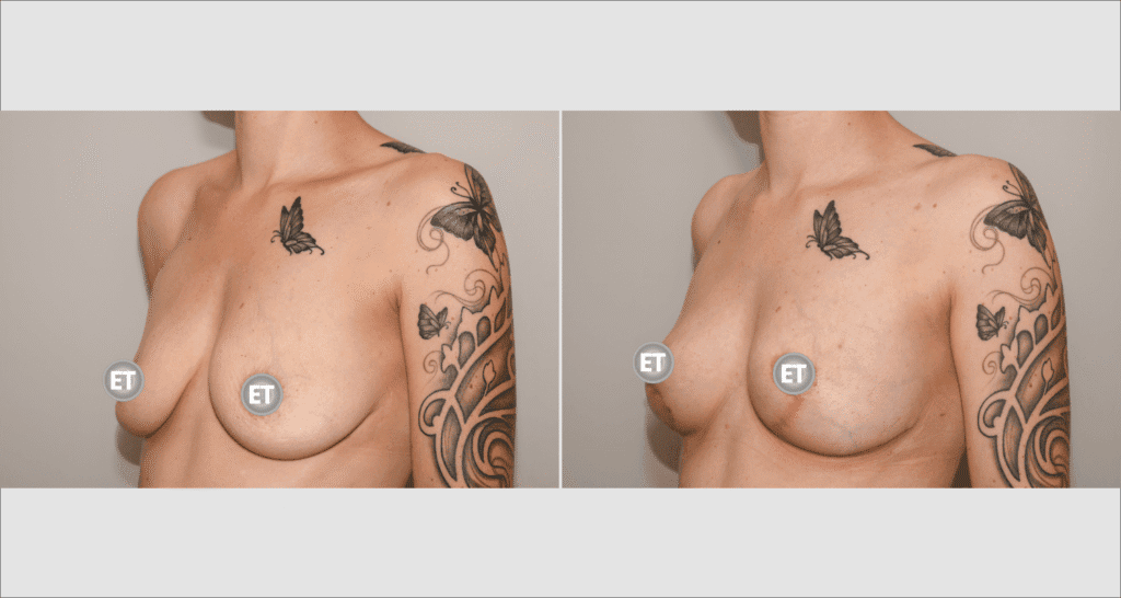 Vorher/Nachher Ergebnis: Bruststraffung