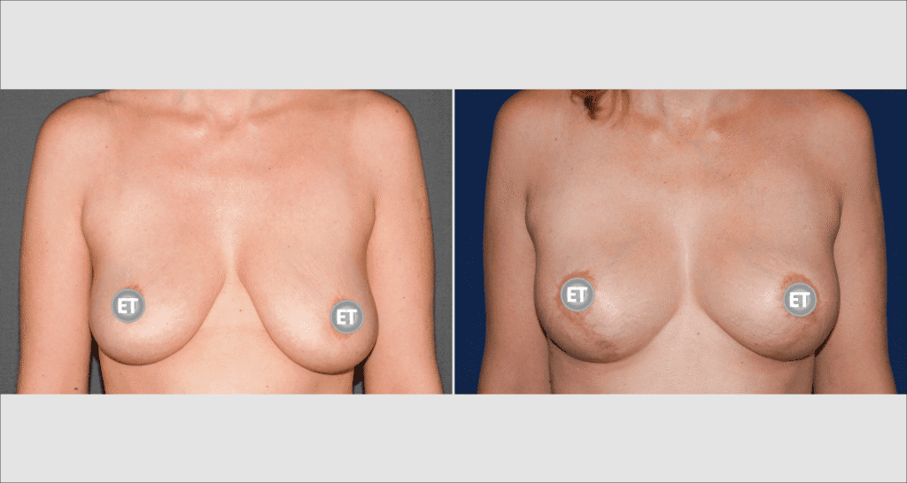 Vorher/Nachher Ergebnis: Bruststraffung