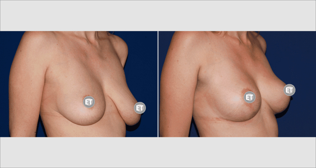 Vorher/Nachher Ergebnis: Bruststraffung