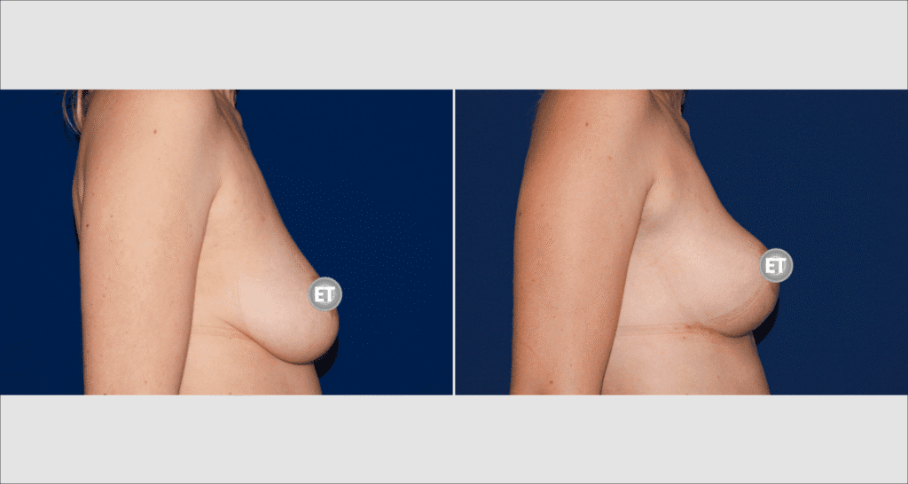 Vorher/Nachher Ergebnis: Bruststraffung