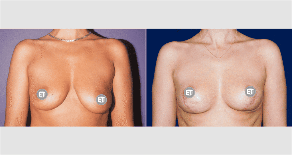 Vorher/Nachher Ergebnis: Bruststraffung