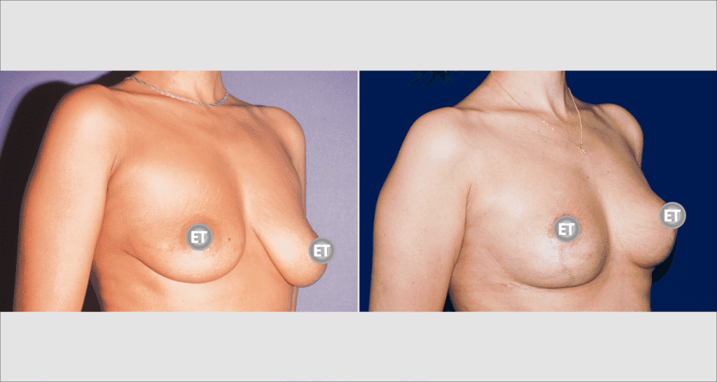 Vorher/Nachher Ergebnis: Bruststraffung