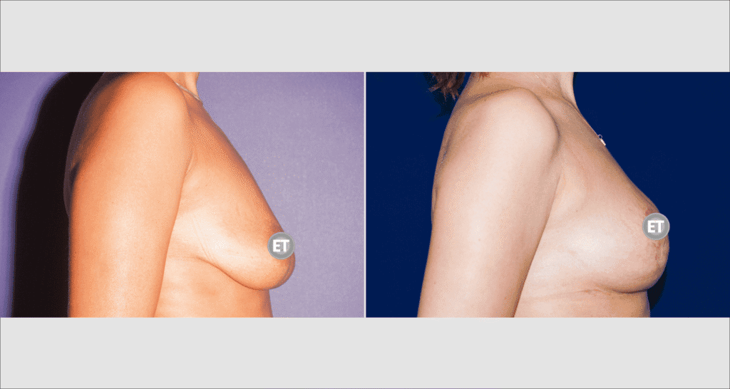 Vorher/Nachher Ergebnis: Bruststraffung