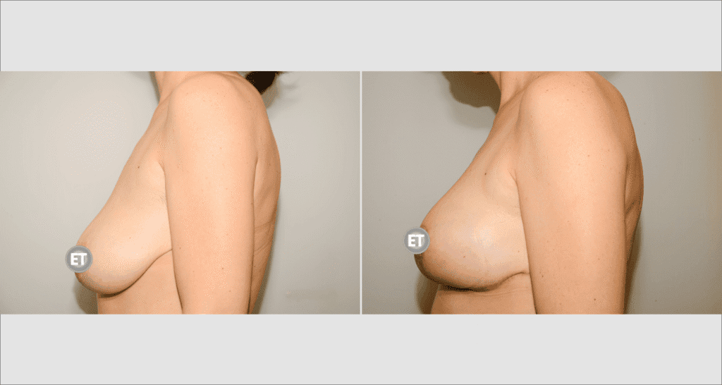 Side view of woman’s breasts before and after breast lift procedure.