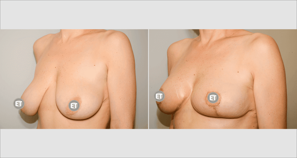Vorher/Nachher Ergebnis: Bruststraffung