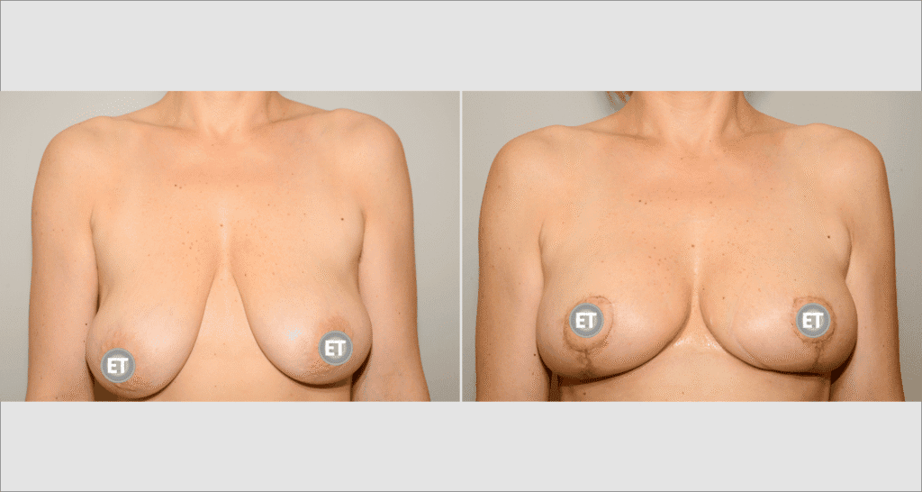 Vorher/Nachher Ergebnis: Bruststraffung