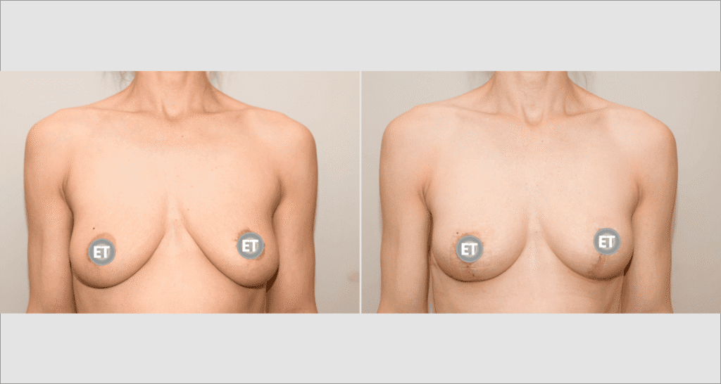 Vorher/Nachher Ergebnis: Bruststraffung