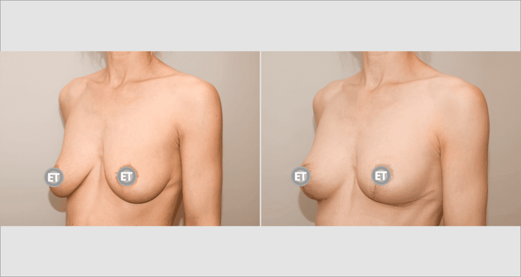 Vorher/Nachher Ergebnis: Bruststraffung