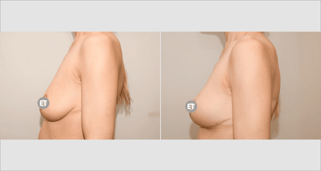 Vorher/Nachher Ergebnis: Bruststraffung
