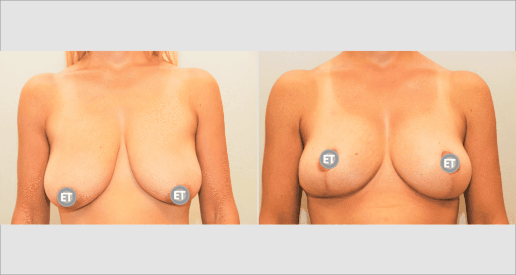 Vorher/Nachher Ergebnis: Bruststraffung