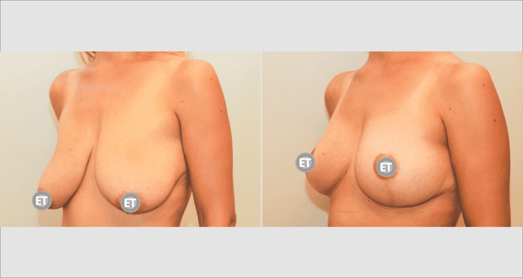 Vorher/Nachher Ergebnis: Bruststraffung