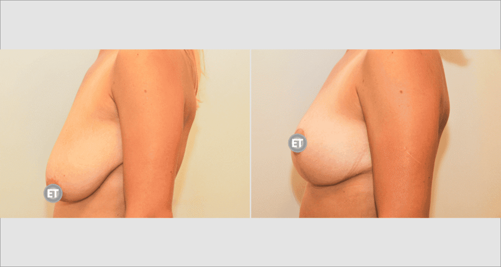 Vorher/Nachher Ergebnis: Bruststraffung