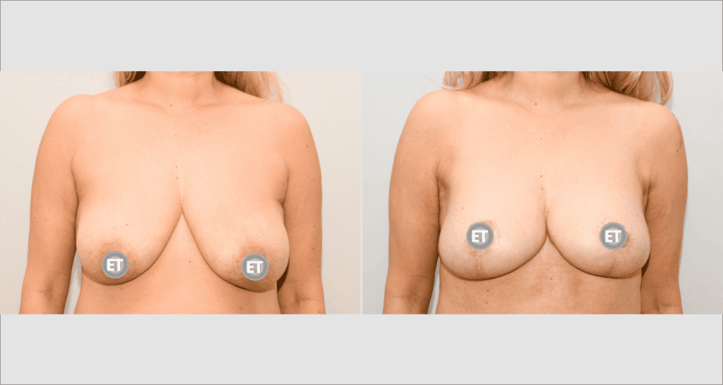 Vorher/Nachher Ergebnis: Bruststraffung