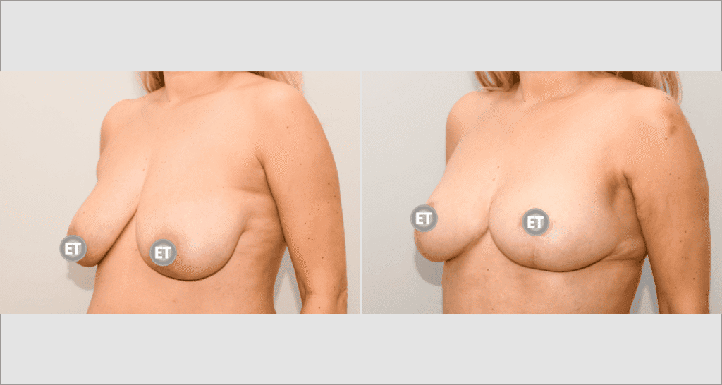 Vorher/Nachher Ergebnis: Bruststraffung