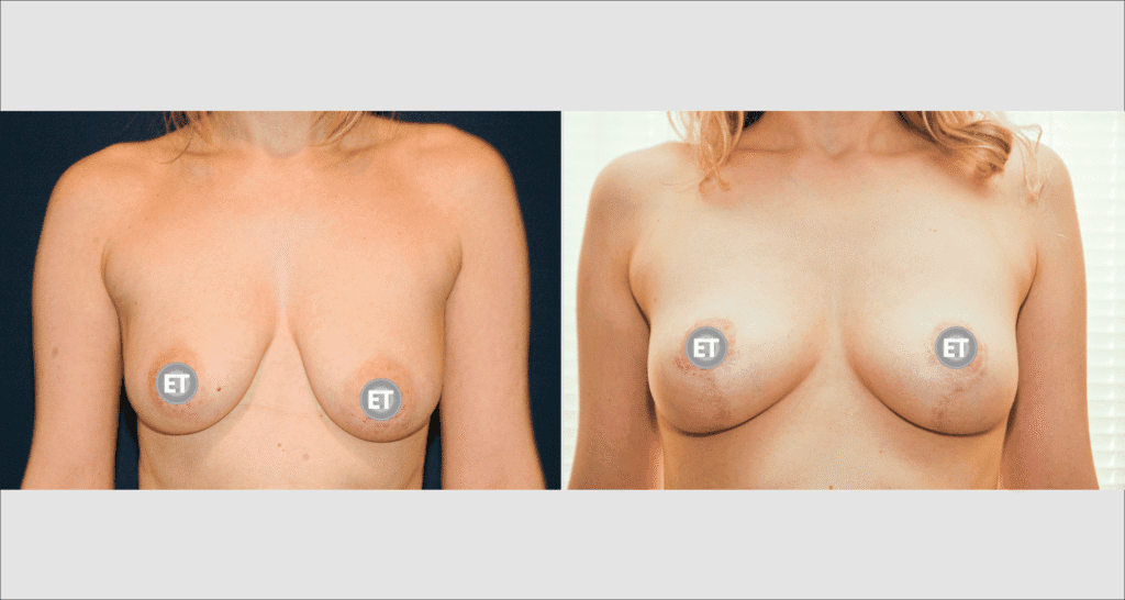 Vorher/Nachher Ergebnis: Bruststraffung