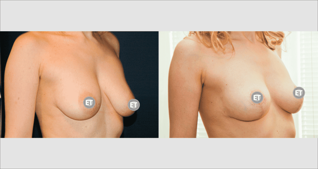 Vorher/Nachher Ergebnis: Bruststraffung