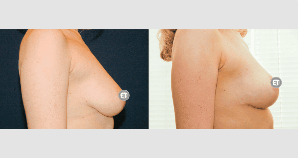 Vorher/Nachher Ergebnis: Bruststraffung