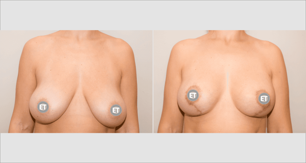 Vorher/Nachher Ergebnis: Bruststraffung