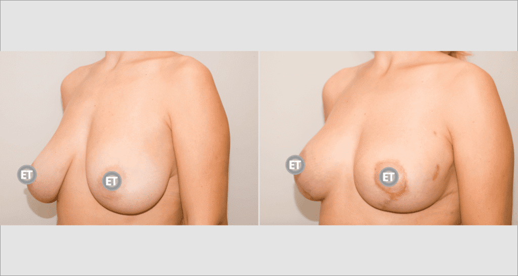 Vorher/Nachher Ergebnis: Bruststraffung