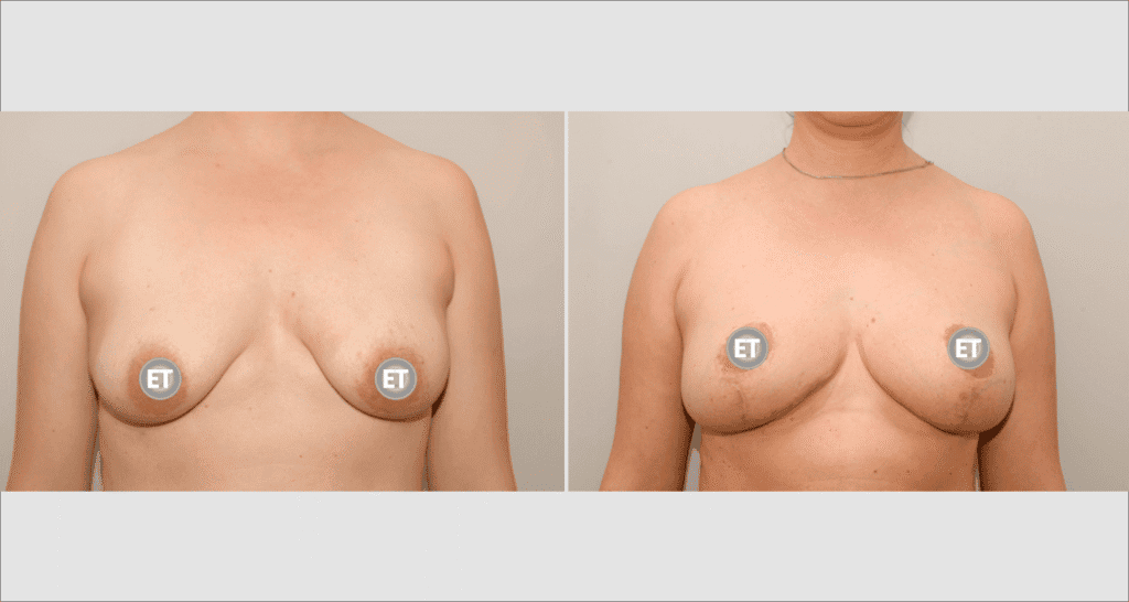 Vorher/Nachher Ergebnis: Bruststraffung