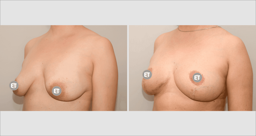 Vorher/Nachher Ergebnis: Bruststraffung
