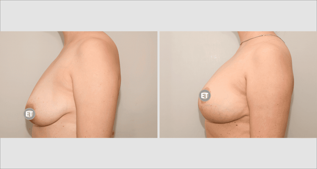 Vorher/Nachher Ergebnis: Bruststraffung