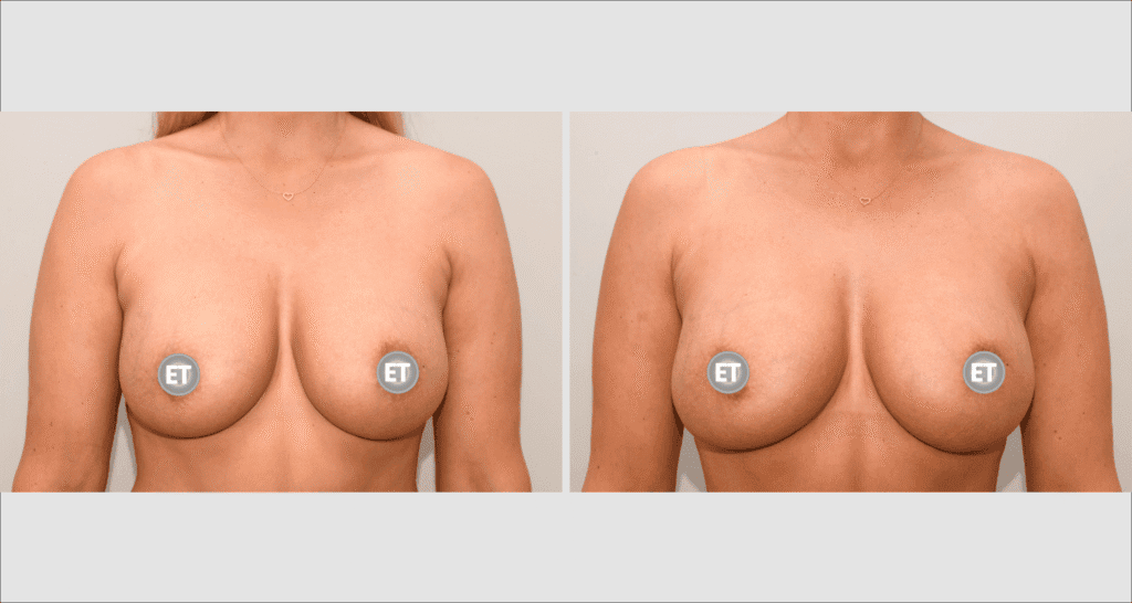 Vorher/Nachher Ergebnis: Brustvergroesserung Mit Eigenfett