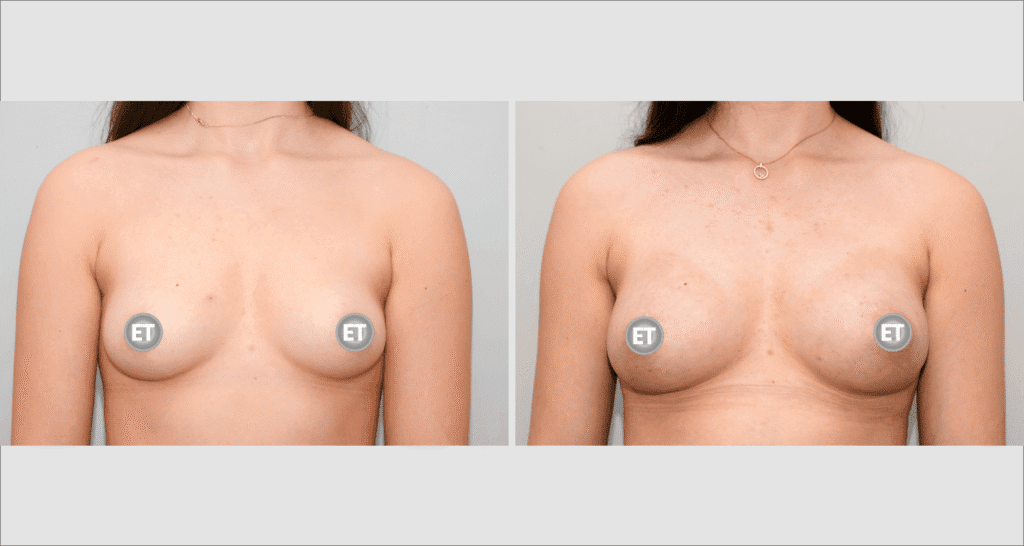 Vorher/Nachher Ergebnis: Brustvergroesserung Mit Eigenfett