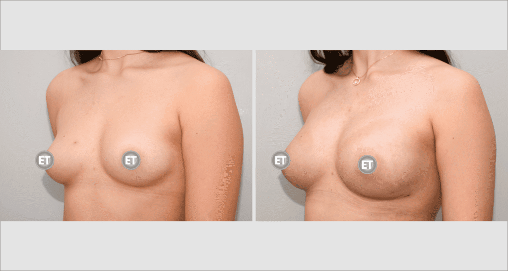 Vorher/Nachher Ergebnis: Brustvergroesserung Mit Eigenfett