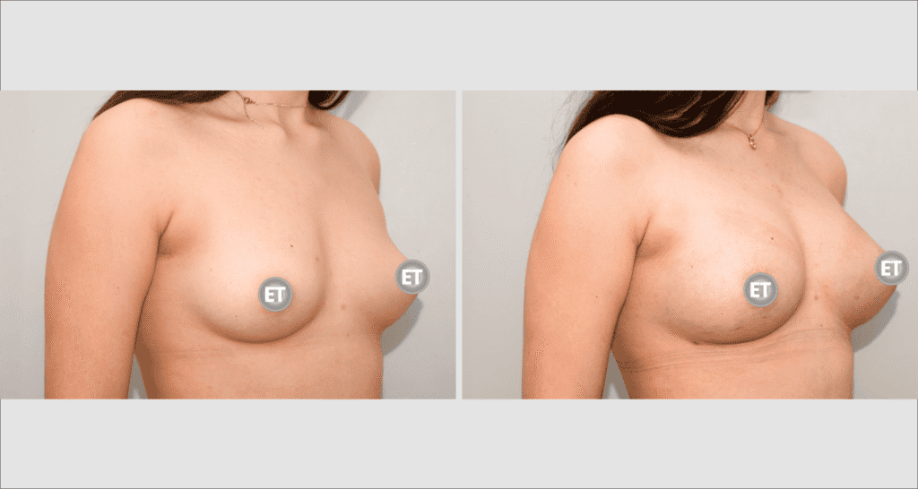 Vorher/Nachher Ergebnis: Brustvergroesserung Mit Eigenfett