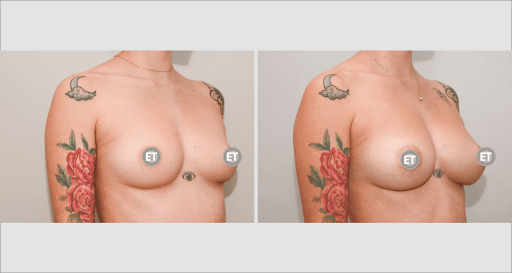Vorher/Nachher Ergebnis: Brustvergroesserung Mit Eigenfett