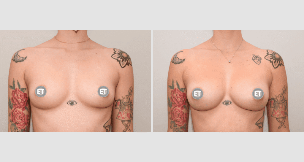 Vorher/Nachher Ergebnis: Brustvergroesserung Mit Eigenfett