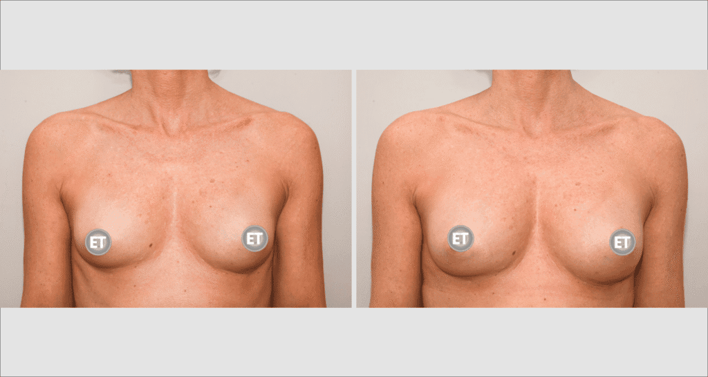 Side-by-side comparison of breast reconstruction results showing improvement.