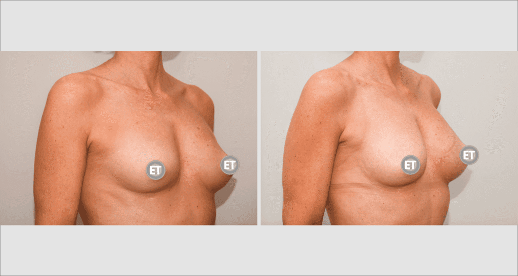 Vorher/Nachher Ergebnis: Brustvergroesserung Mit Eigenfett