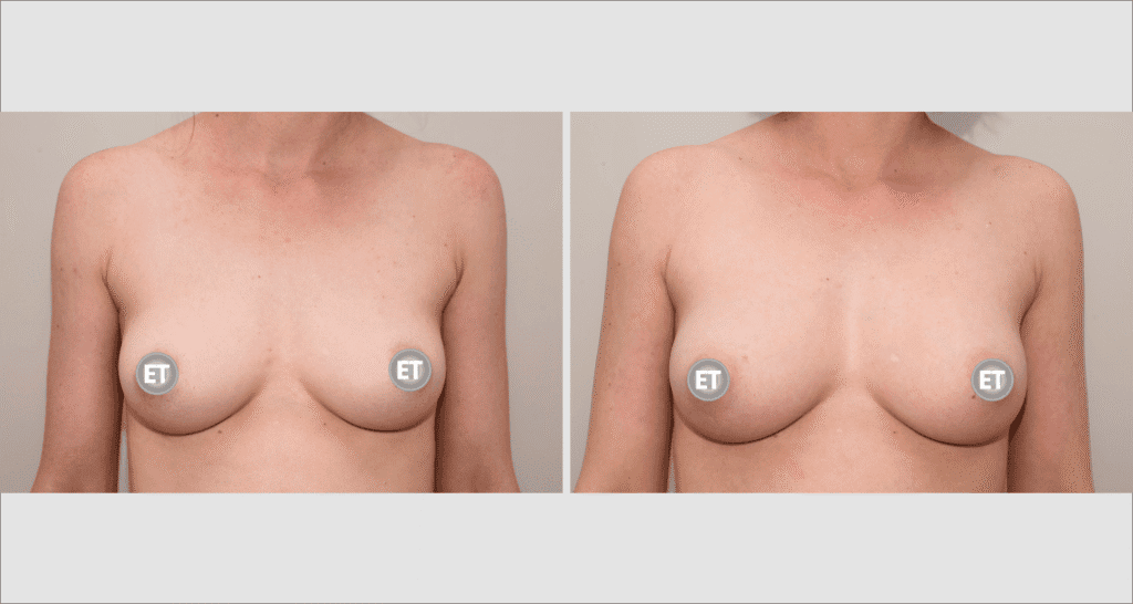 Vorher/Nachher Ergebnis: Brustvergroesserung Mit Eigenfett