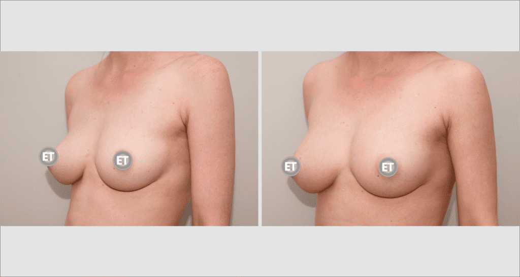 Vorher/Nachher Ergebnis: Brustvergroesserung Mit Eigenfett