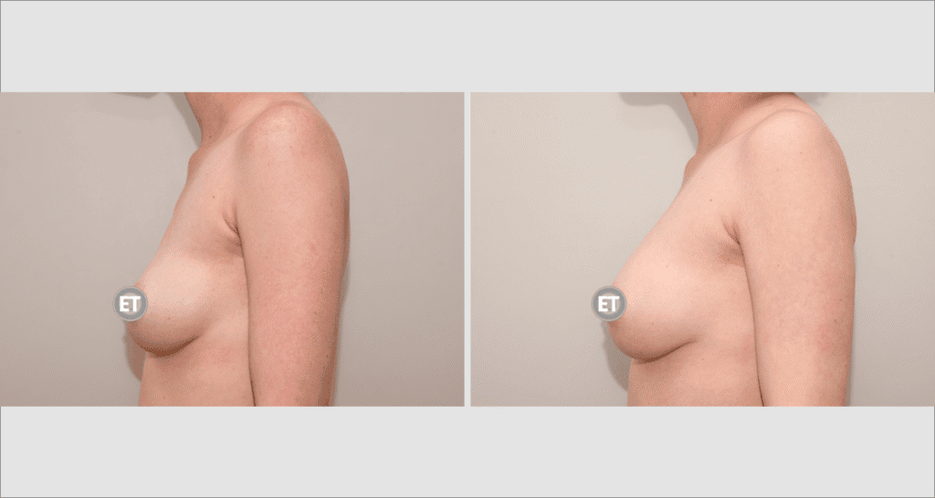 Vorher/Nachher Ergebnis: Brustvergroesserung Mit Eigenfett