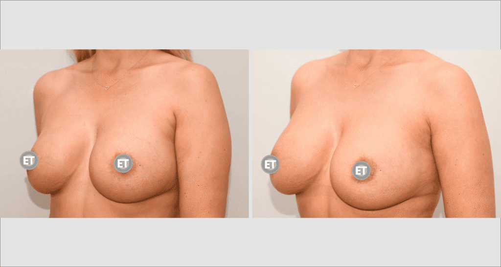 Vorher/Nachher Ergebnis: Brustvergroesserung Mit Eigenfett