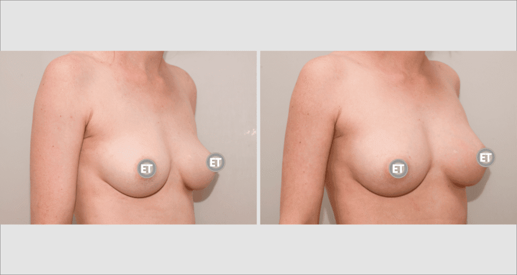 Vorher/Nachher Ergebnis: Brustvergroesserung Mit Eigenfett