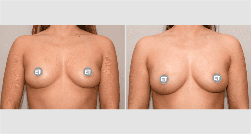 Vorher/Nachher Ergebnis: Brustvergroesserung Mit Eigenfett