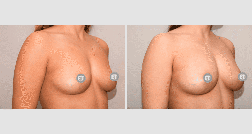 Vorher/Nachher Ergebnis: Brustvergroesserung Mit Eigenfett