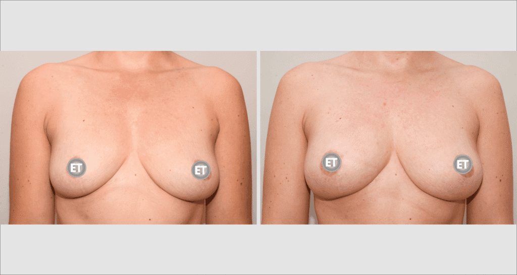 Vorher/Nachher Ergebnis: Brustvergroesserung Mit Eigenfett