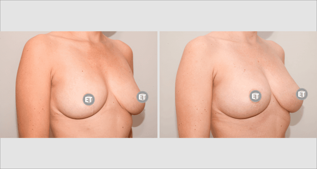Vorher/Nachher Ergebnis: Brustvergroesserung Mit Eigenfett