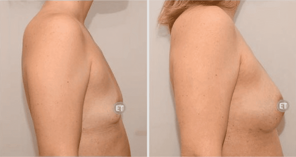 Vorher/Nachher Ergebnis: Brustvergroesserung Mit Eigenfett