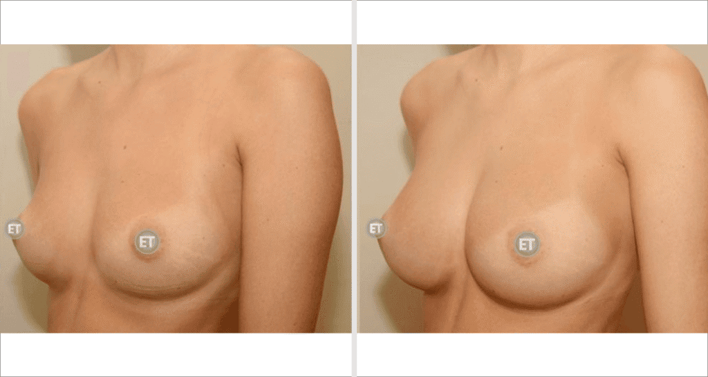 Vorher/Nachher Ergebnis: Brustvergroesserung Mit Eigenfett