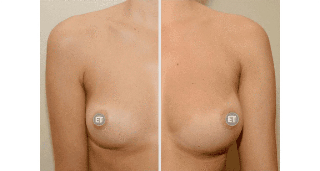 Vorher/Nachher Ergebnis: Brustvergroesserung Mit Eigenfett