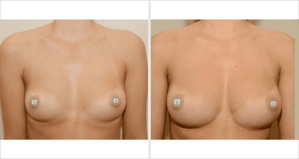 Vorher/Nachher Ergebnis: Brustvergroesserung Mit Eigenfett
