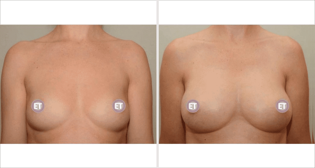 Vorher/Nachher Ergebnis: Brustvergroesserung Mit Eigenfett