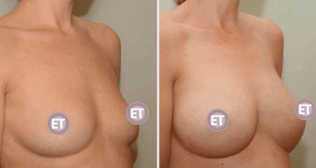 Vorher/Nachher Ergebnis: Brustvergroesserung Mit Eigenfett
