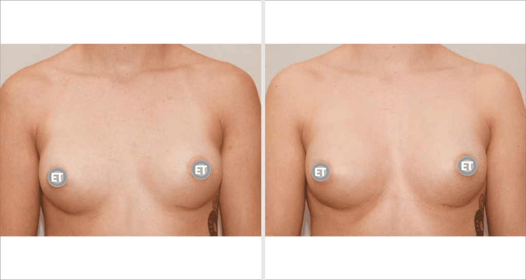 Vorher/Nachher Ergebnis: Brustvergroesserung Mit Eigenfett